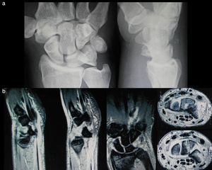 a) Radiografía preoperatoria mostrando la luxación del piramidal. b) Imágenes de resonancia magnética preoperatorias.