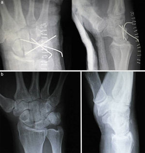 a) Control radiológico tras la reducción abierta y síntesis con agujas. b) Radiografías postoperatorias en el control realizado a los 4 años de la cirugía.