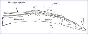 Técnica simplificada de Zancolli o técnica de Chevallard. El tendón flexor superficial del dedo seleccionado es suturado directamente al borde proximal de la polea A2 (sin desinserción) previa realización de una hiperextensión pasiva del dedo.