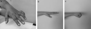 Deformidad en garra de la mano corregida satisfactoriamente con la técnica de Chevallard. a) Imagen clínica preoperatoria. b) Imagen clínica lateral postoperatoria con los dedos extendidos. c) Imagen clínica lateral postoperatoria con los dedos en flexión.