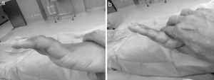 Maniobra de Bouvier. a) Posición inicial de la mano. b) Al prevenir la hiperextensión de la articulaciones MCF por presión dorsal sobre las falanges proximales, se logra la extensión completa de las articulaciones IF.