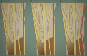 El tendón del extensor carpi ulnaris (ECU) a nivel de la muñeca en color rojo. A y B) Representan el antebrazo en posición neutra y en pronación máxima. C) Representa la oblicuidad del tendón cuando el antebrazo se encuentra en máxima supinación. Ha quedado demostrado que cuanto mayor es la angulación, mayor es su efecto pronador.