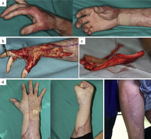 a) Varón de 49 años con secuelas de quemaduras en la mano derecha: retracción cutánea en muñeca y primera comisura. b) Resección del tejido cicatricial. c) Cobertura mediante colgajo anterolateral del muslo-disección. La imagen muestra como la disección por encima de la fascia de Scarpa permite sacar un colgajo fasciograso fino. d) Resultado final sin necesidad de adelgazamiento posterior del colgajo y cierre directo de la zona donante.
