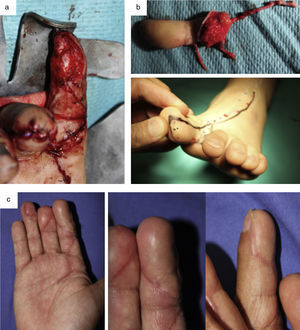 a) Varón de 53 años con pérdida del pulpejo del 2.o dedo de la mano derecha (dominante). b) Diseño y transferencia de hemipulpejo del pie. c) Aspecto final de la mano, con una apariencia y función muy similares al pulpejo nativo.
