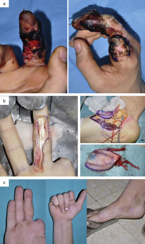 a) Varón de 19 años con amputación del 2.o dedo y lesiones en el 3.er dedo de la mano derecha (dominante) tras el atrapamiento con una radial. b) Desbridamiento y transferencia de colgajo libre medialis pedis para reconstruir el 3.er dedo. c) Resultado final a los 3 meses en la zona donante y en la zona receptora.