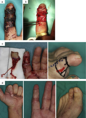 Varón de 41 años con degloving del 2.o dedo de la mano izquierda y avulsión de ambos nervios colaterales. a) Necrosis cutánea posterior tras revascularización (lesión nerviosa no reparable inicialmente mediante sutura nerviosa directa). b) Desbridamiento de tejido necrótico. c) Diseño y transferencia de colgajo neurocutáneo del 2.o dedo del pie. d) Resultado a los 6 meses en la zona donante y en la zona receptora.