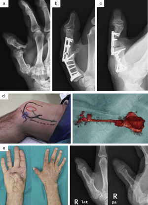 a) Varón de 37 años con seudoartrosis en F1 del pulgar y fracaso de la artrodesis metacarpofalángica de la mano derecha. b) Imagen radiológica del postoperatorio inmediato tras el injerto y la nueva fijación con placa. c) Reabsorción del injerto óseo a los 2 meses. d) Diseño y transferencia de colgajo corticoperióstico. e) Resultado clínico y radiológico con consolidación completa a los 5 meses.