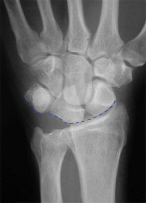 Imagen de una disociación lunopiramidal en la que el arco de Gilula formado por la superficie proximal de la hilera proximal del carpo se ve alterado.