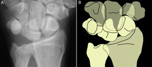 Semilunar con forma de «semiluna» en la que la parte más triangular de la figura constituye el borde dorsal del semilunar que está superpuesto a la porción distal y dorsal del hueso grande.