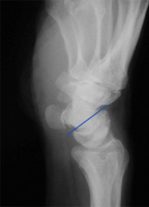Radiografía lateral en la que se observa una deformidad estática en VISI con el semilunar en flexión.