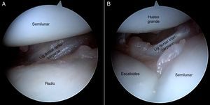 Visión de los ligamentos dorsales desde el portal volar central en muñeca derecha. A)Visión del ligamento radiocarpiano dorsal en la articulación radiocarpiana. B)Visión del ligamento intercarpiano dorsal en la articulación mediocarpiana.