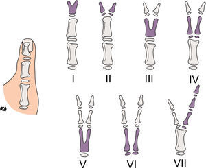 Clasificación de las duplicaciones del pulgar según Wassel.