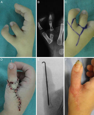 Técnica tipo on top plasty. Aspecto clínico (A) y radiológico (B) inicial. Diseño de las incisiones (C). Al término de la intervención (D) y Rx postoperatoria (E). Aspecto final (F).