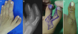 Duplicación tipo VII Wassel. Aspecto clínico (A) y radiológico (B). Diseño de las incisiones (C). Conservación del pulgar radial. Osteotomía fijada con aguja (D).