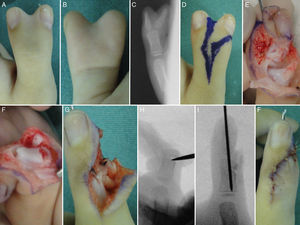 Duplicación tipo II (A, B y C). Técnica de resección-reconstrucción: colgajo radial (D). Cabeza F1 exageradamente ancha (E). Su condroplastia con bisturí (F). Reinserción del LC y alineación del EPL (G). Osteotomía incompleta en el cuello de F1 (H) y su fijación (I). Sutura del colgajo radial (F).