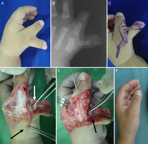 Duplicación compleja: el pulgar radial presenta 2 falanges distales (A y B). Diseño de las incisiones (C), tendón EPL y LCRa (D), ya suturados (E). Aspecto final (F).