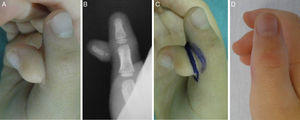Pulgar flotante. Aspecto clínico (A) y radiológico (B). Cirugía al año de edad, con resección elíptica (C). Aspecto final (D).