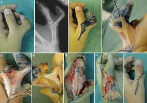 Pulgar tipo IV Wassel (A) y su Rx (B). Diseño incisión (C). Nervio colateral (D). Duplicación del EPL (E) y del FPL (F). Reinserción del tendón extensor (G) y del APB (H). Cierre del colgajo (I).