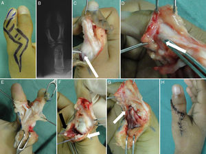 Duplicación del pulgar (A), Rx (B). Disección (C y D). FPL bifurcado (E). Preparación y sutura del LC y APB (F y G). Cierre cutáneo (H).