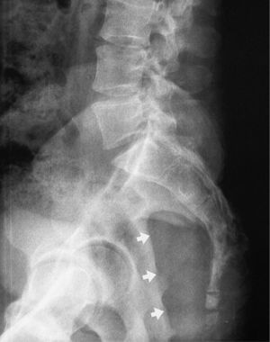 Radiografía simple de columna lumbo-sacra. Proyección lateral. Lesión con efecto masa en la zona posterior de la pelvis menor (flechas) y alteración de la textura ósea sacrococcígea con algún componente lítico.
