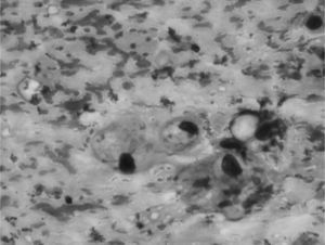 Biopsia de masa sacra. Destaca la presencia de elementos celulares multivacuolados que forman placas (células fisalíferas) sobre un fondo de material mixoide metacromático.
