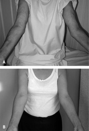A: cambios de consistencia de la piel, con piel de naranja (pel d
