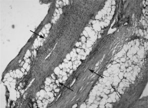 Proceso inflamatorio linfocítico intenso con engrosamiento de la fascia muscular e infiltración difusa de tejido muscular y graso adyacente (HE, 3 × 25).
