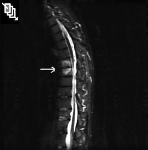 Resonancia magnética de columna dorsal, corte sagital con secuencia STIR: muestra una imagen hiperintensa en T2 compatible con una lesión de Anderson de grado C1 (edema en cuerpo vertebral) a nivel de D7 y D8; una lesión hiperintensa a nivel de L1-L2 compatible con una lesión de Anderson grado C2 (recambio graso) y un acuñamiento anterior osteoporótico de D12 sin signos de edema.
