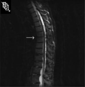 Resonancia magnética de columna dorsal de control, corte sagital con secuencia STIR: se observa una resolución completa de la espondilodiscitis a nivel de D7-D8, con sustitución grasa y sin signos indicativos de actividad inflamatoria osteodiscal. El resto, sin cambios respecto a la previa.
