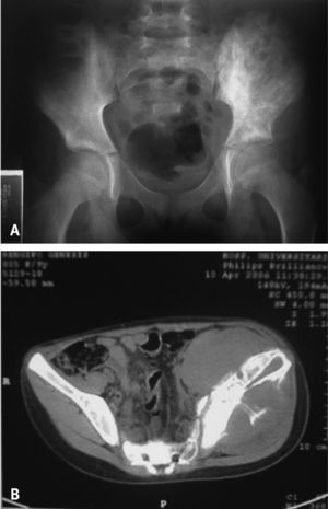 Imágenes de pelvis ósea del caso 1. A: radiografía simple de pelvis que muestra esclerosis y lesiones líticas en el hueso ilíaco izquierdo. B: tomografía de pelvis ósea que muestra tumoración que rodea el hueso ilíaco, lesiones osteolíticas y periostitis.