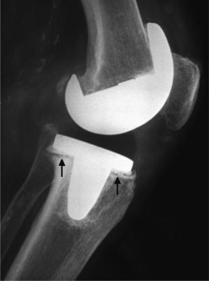 Proyección radiográfica lateral de la prótesis de la rodilla izquierda de la paciente donde se visualiza una línea radiotransparente irregular en la interfase entre el cemento y el metal del componente tibial (aflojamiento séptico).