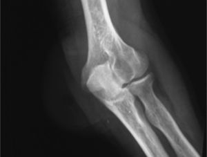 Fadiografía anteroposterior del codo.