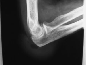 Radiografía lateral del codo.