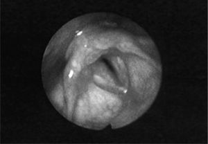 Nasofibrolaryngoscopic findings during an acute dyspnea episode. The Figure shows arytenoid oedema and hyperemia, moderate oedema of the posterior commisure, severe sulcus subglotticus and ventricular obliteration, with a 70% luminal narrowing.
