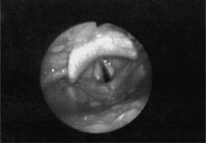 Nasofibrolaryngoscopic findings after treatment for extraoesophageal reflux disease. One month after diagnosis and treatment initiation, there is a decrease in the arytenoid and commisural oedema, important decrese of the sulcus subglotticus, and a 50% luminal patency.