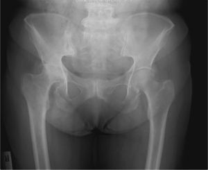 Radiografía simple de pelvis en proyección anteroposterior: se observa osteonecrosis de la cabeza femoral derecha con deformidad y colapso.