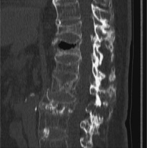 Imagen de la tomografía computarizada que muestra vacío intravertebral en la vértebra dorsal 12.