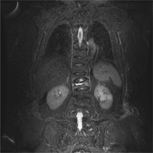 Imagen de la resonancia magnética en fase de secuencia de supresión grasa. Puede verse la imagen de vacío intravertebral y ocupación con edema óseo de la vértebra dorsal 12.