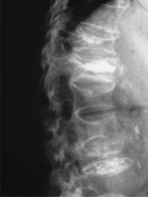 Imagen radiográfica de vertebroplastia D12 y D11.