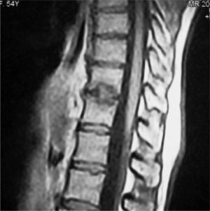 Imagen de resonancia magnética en ponderación T1 en la que se observa fractura cortical del platillo vertebral del soma T12 e imagen en forma de cúpula hipointensa en los somas T11 y T12, compatible con hernia de Schmorl.