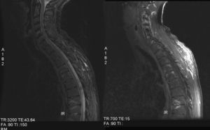 Afectación inflamatoria en la columna. Se aprecia hiperintensidad en secuencia STIR y T1 con gadolinio, que afecta a múltiples cuerpos vertebrales de la columna torácica.