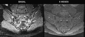 Respuesta al tratamiento con adalimumab. Sacroileítis bilateral en resonancia basal que desaparece a los 6 meses de comenzar el tratamiento con adalimumab.