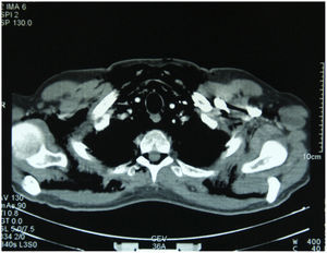 Neumonediastino con extenso enfisema.