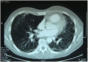 Neumopatía intersticial con panalización bilateral.