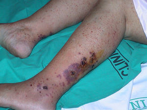 Púrpura palpable en una paciente con crioglobulinemia e infección por el virus de la hepatitis C.