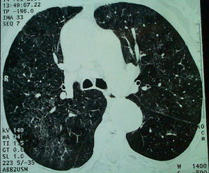 Alveolitis pulmonar en un paciente con crioglobulinemia en relación con el virus de la hepatitis C.