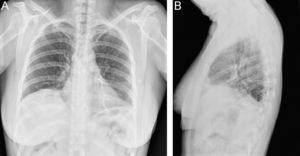 Radiografía de tórax simple. A: frente. B: perfil.