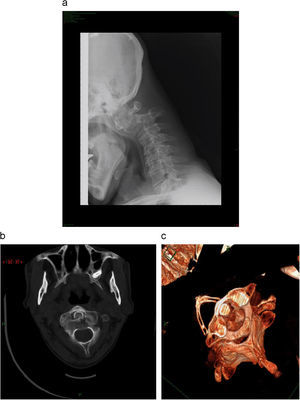 a: radiografía cervical, proyección lateral. Se observa alteración del alineamiento de los cuerpos vertebrales de C1 y C2, con desplazamiento anterior del atlas sobre el axis. b: tomografía computarizada (TC) helicoidal de columna cervical, corte axial. Fractura de C2 que afecta a la apófisis odontoides y parte anterior e izquierda del cuerpo, con luxación de las carillas articulares de C1 y C2. c: TC helicoidal de columna cervical. Reconstrucción retrospectiva tridimensional.