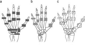 Áreas de evaluación del método Kaye. a) Catorce áreas para la interlínea. b) Once áreas para las erosiones. c) Quince áreas de evaluación de alineación.