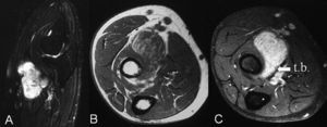 Resonancia magnética. Masa que rodea parcialmente a la porción distal del tendón bicipital (t.b.) en la que se observan las proliferaciones grasas vellositarias isointensas con la señal del tejido celular subcutáneo. La orientación de la imagen sagital equivale aproximadamente a la imagen ecográfica de la figura 1. A) Imagen sagital FSE T2 con supresión grasa. B) Imagen axial FSE T1. C) Imagen axial FSE T1 con contraste. FSE: fast spin-echo 